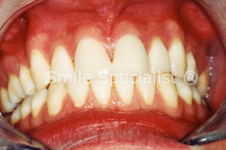 Just one Example of Specialist Dr.Kilcoyne's Cosmetic Ceramic Crowns